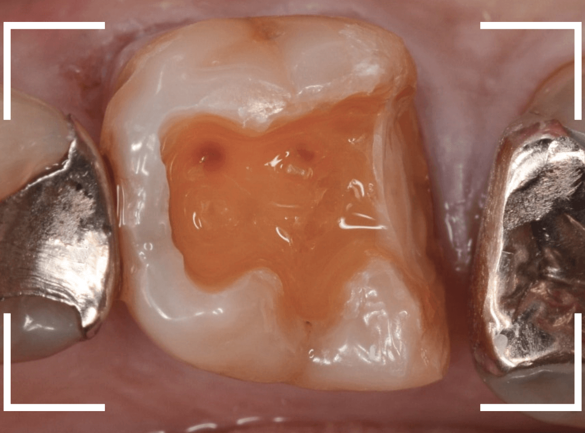 セラミック治療(インレー)17-3