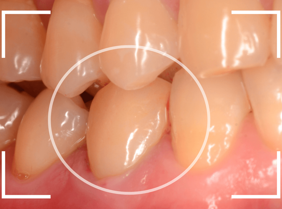 セラミック治療(クラウン・奥歯)11-5