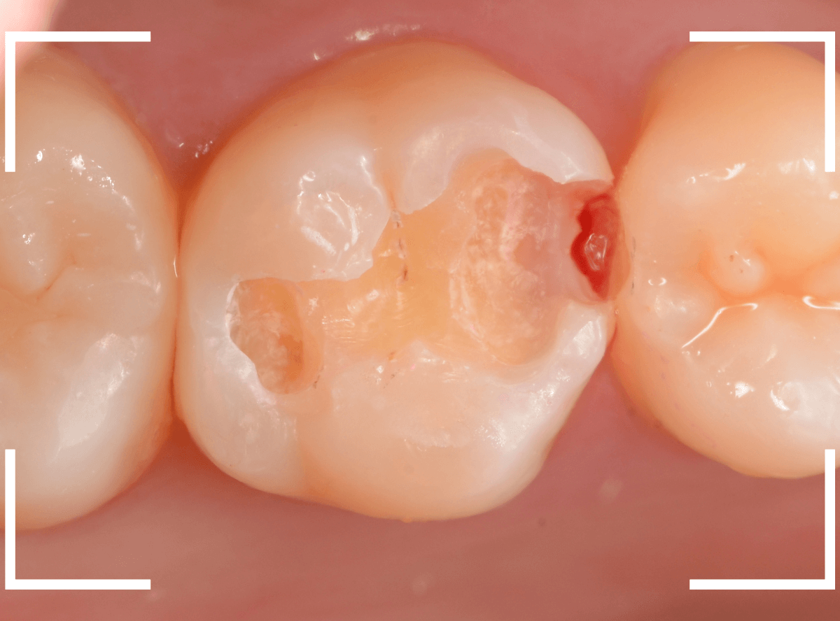 歯と歯の間の虫歯24-5