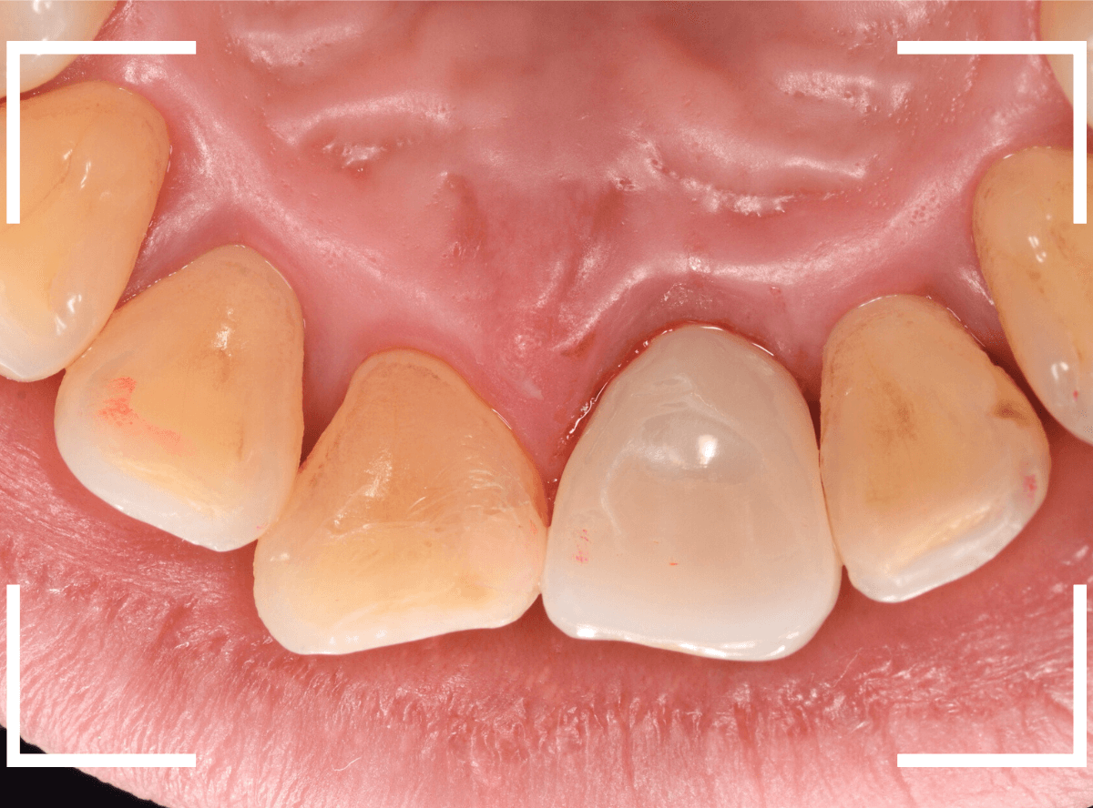 セラミック治療(前歯・クラウン)5-11