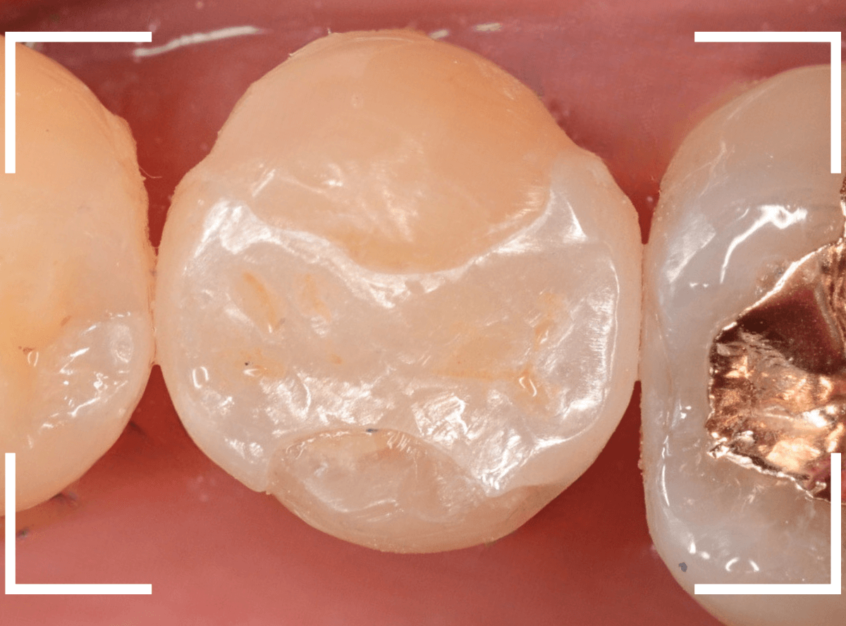 セラミック治療(インレー)25-4