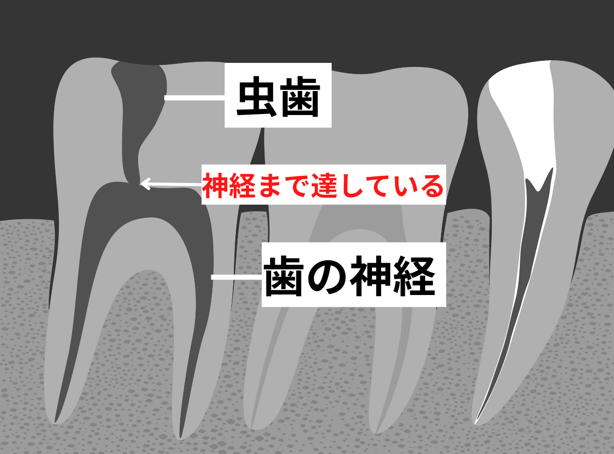 診断がつきづらい虫歯