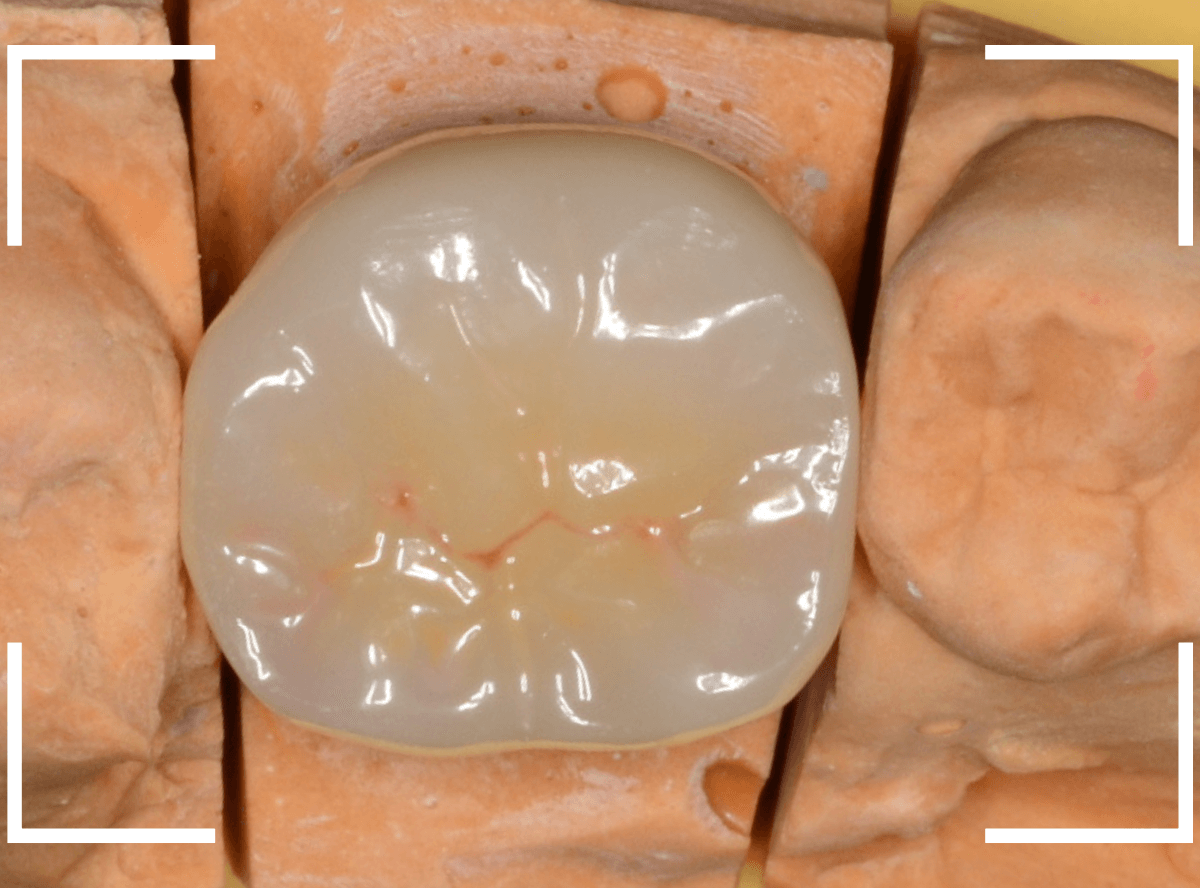 セラミック治療(クラウン・奥歯)15-3