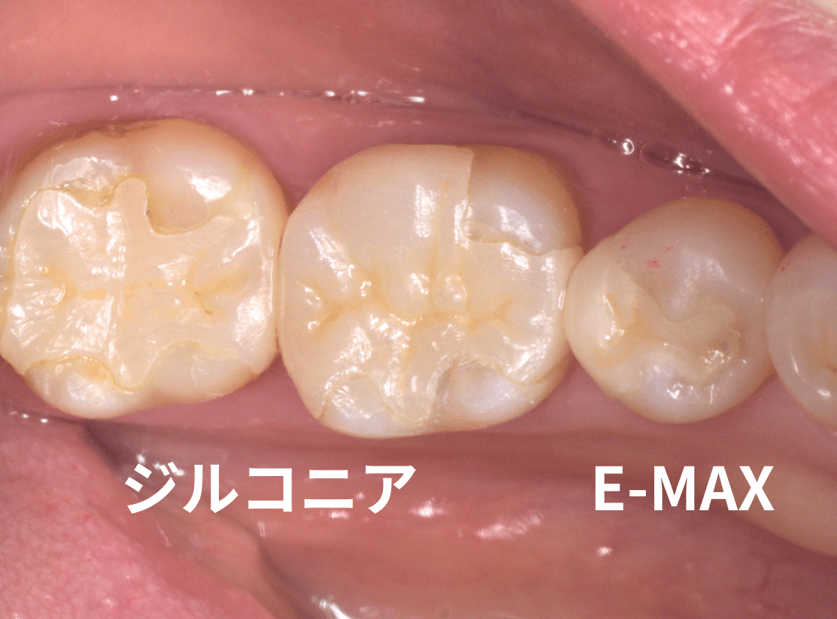 セラミック治療(インレー)8-5