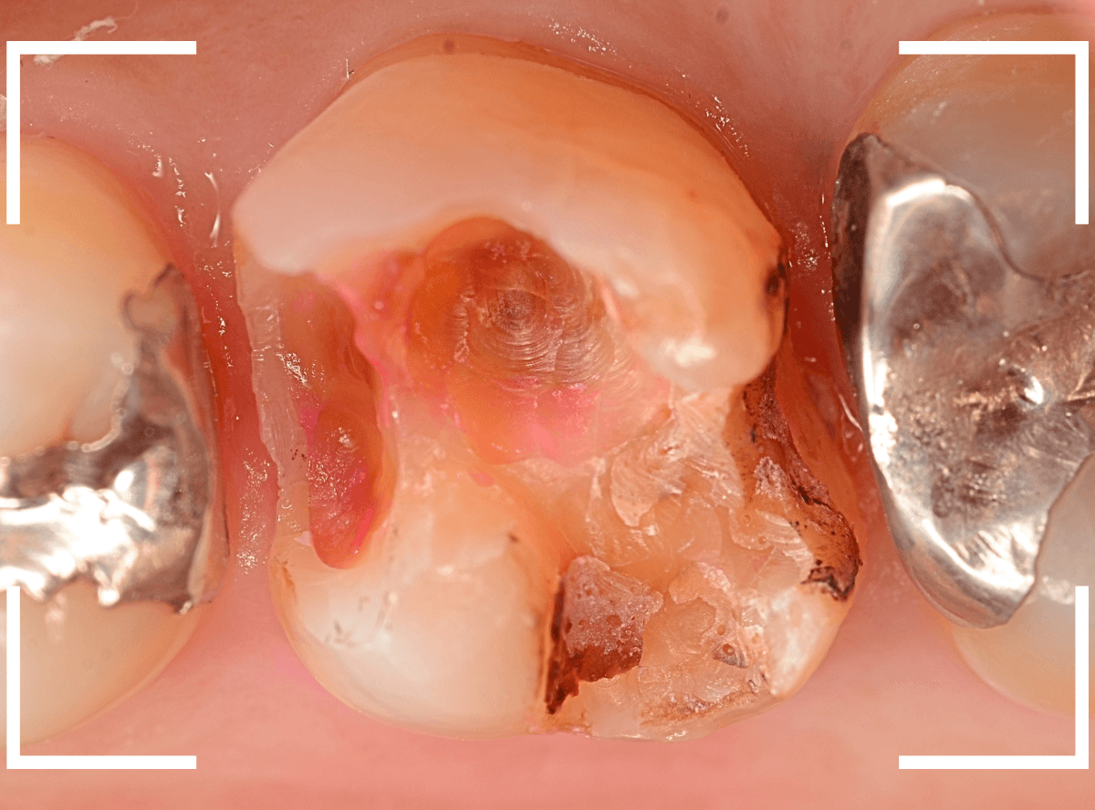 つめものの下の深い虫歯(画像)10-1