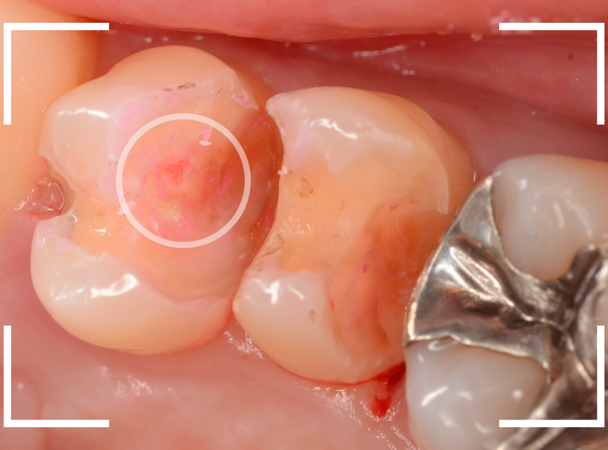 歯と歯の間の虫歯21-1