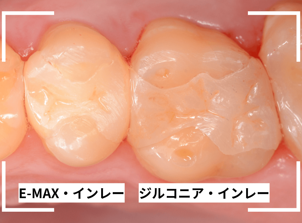 セラミック治療(インレー)24-10