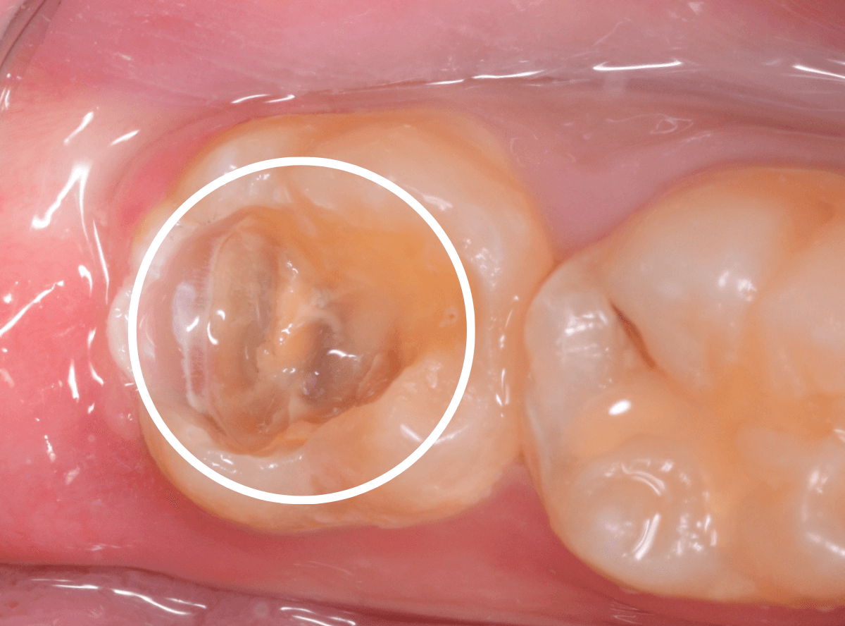 つめものの下の深い深い虫歯11-1