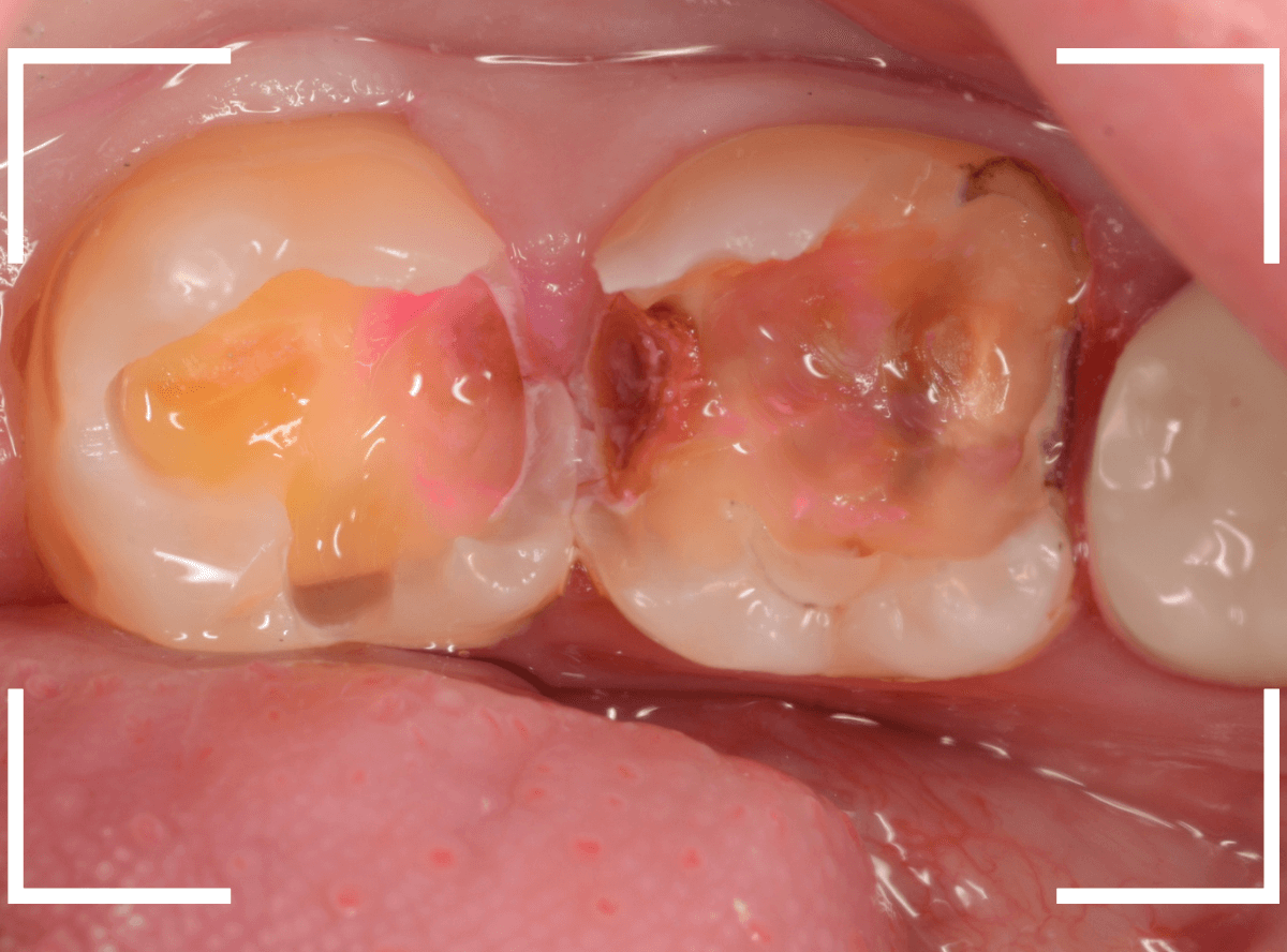 歯と歯の間の虫歯18-5