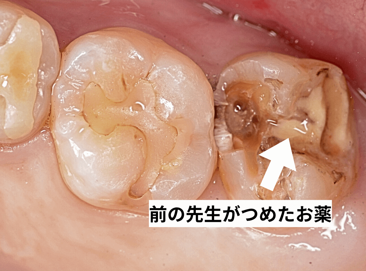 つめものの下の深い虫歯(画像)6-1