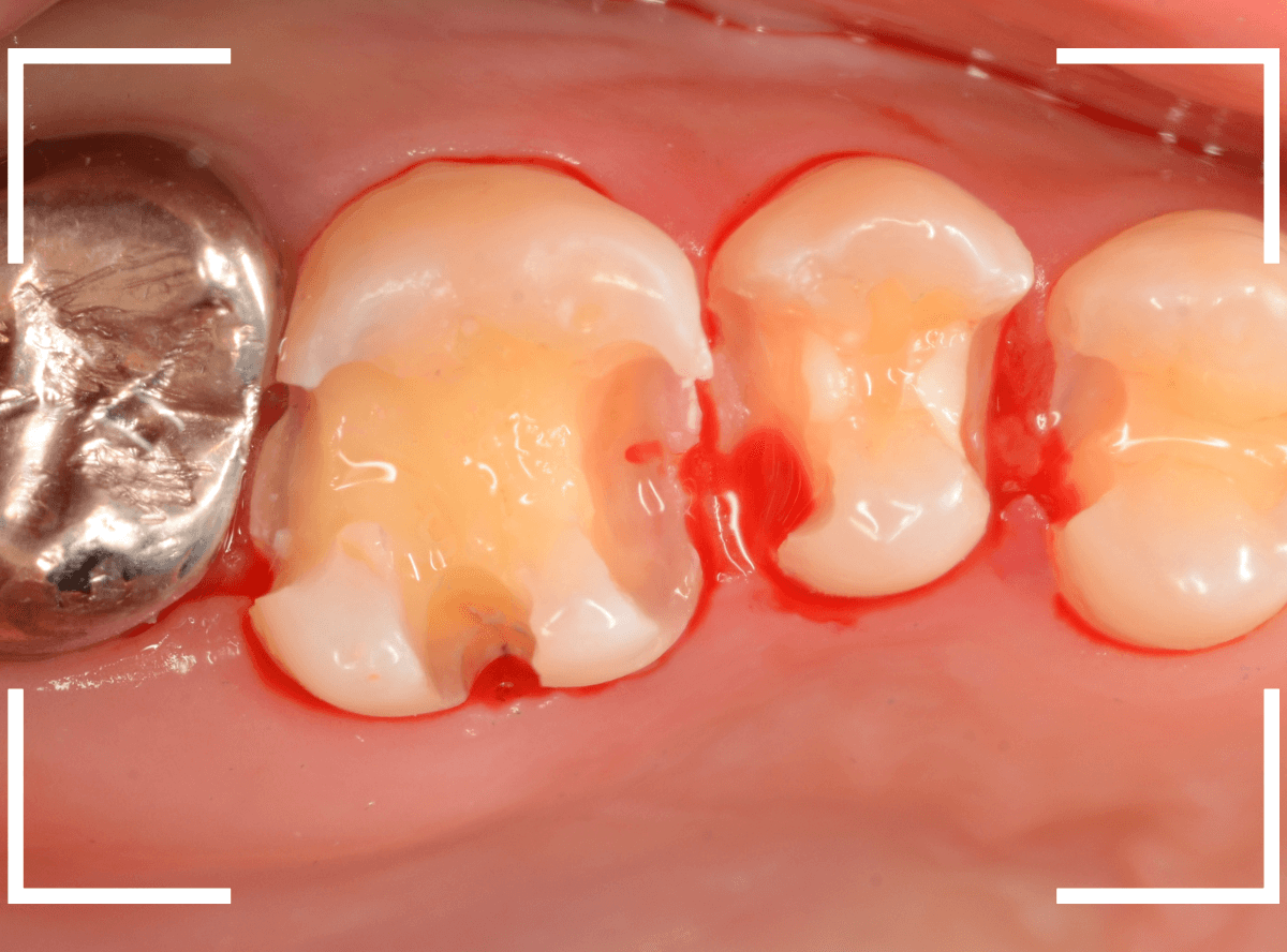 レントゲンでわかりづらい虫歯15-7