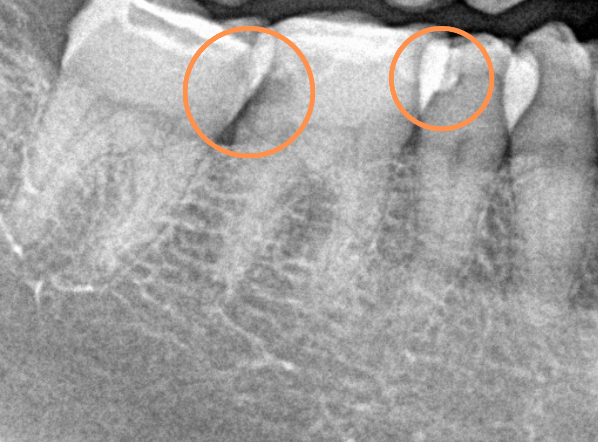 セラミック治療(インレー)8-3