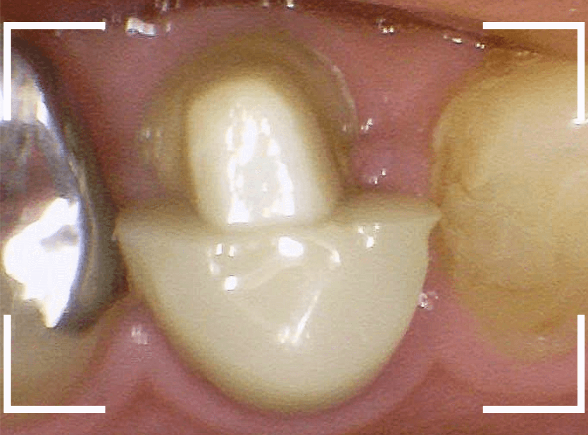 セラミック治療(クラウン・奥歯)14-1