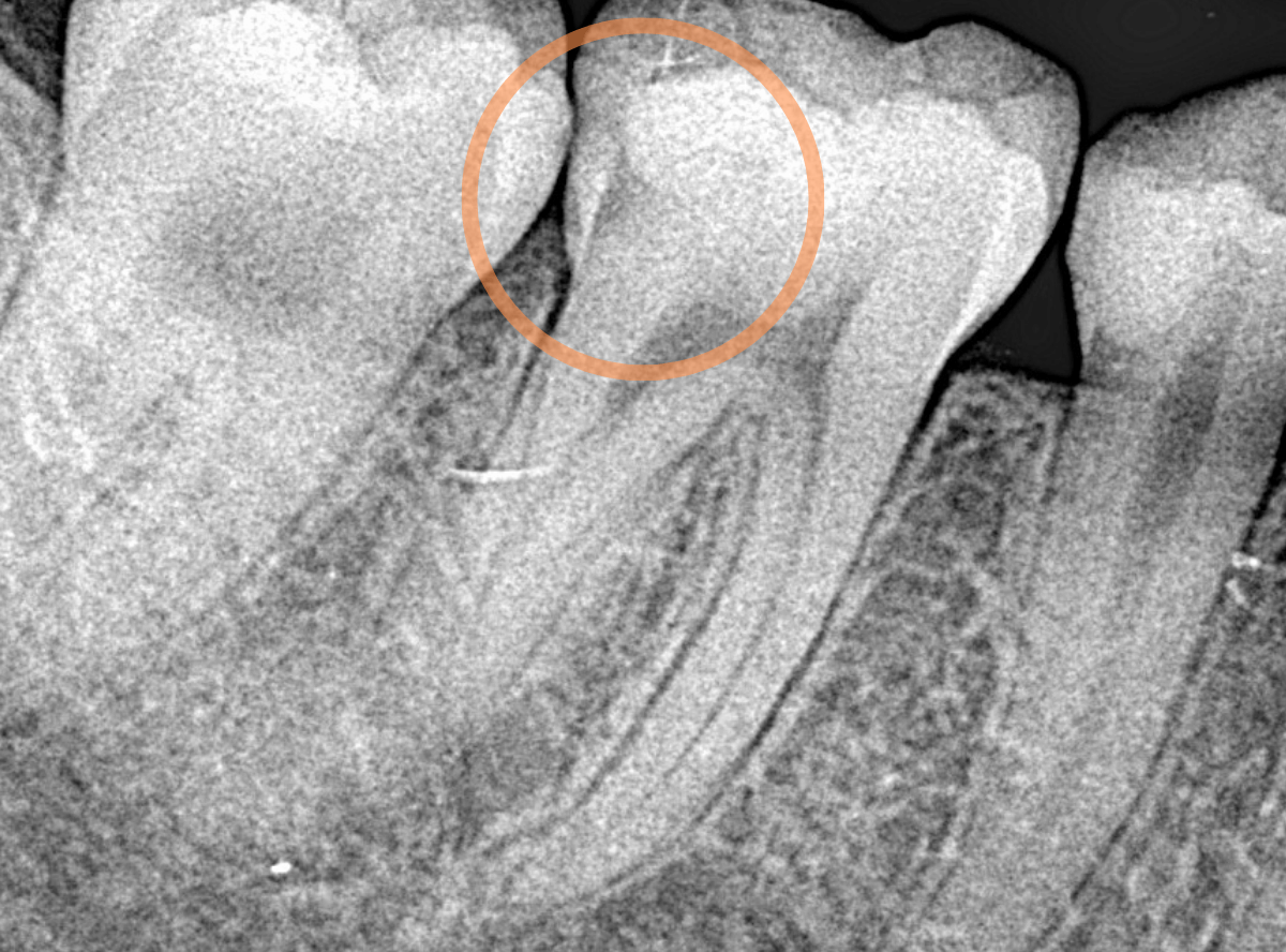 セラミック治療(インレー)7-3