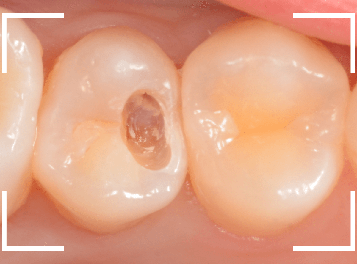 セラミック治療(インレー)32-6