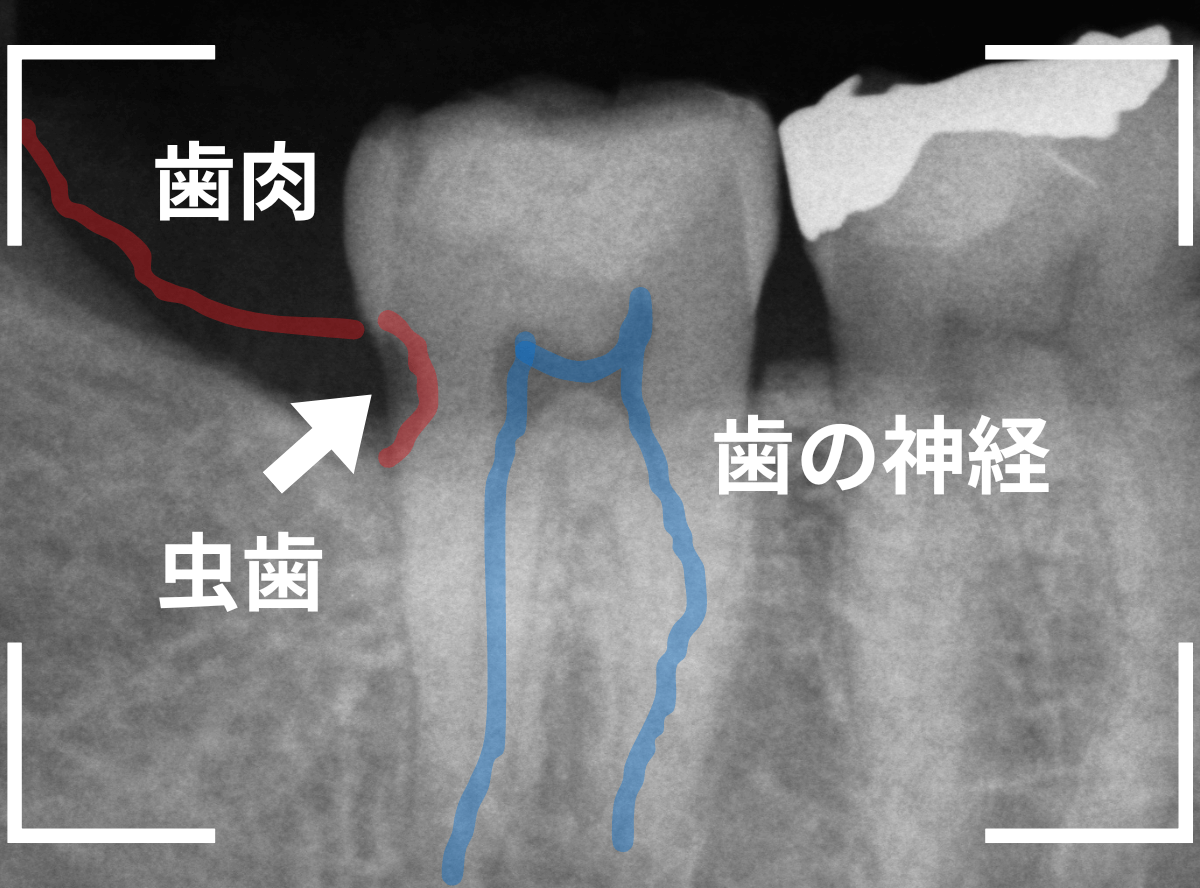 気づかないうちに深い虫歯13-2