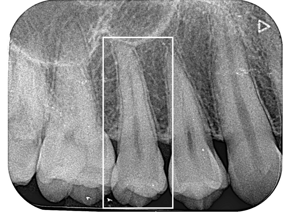 レントゲンでわかりづらい虫歯2-3