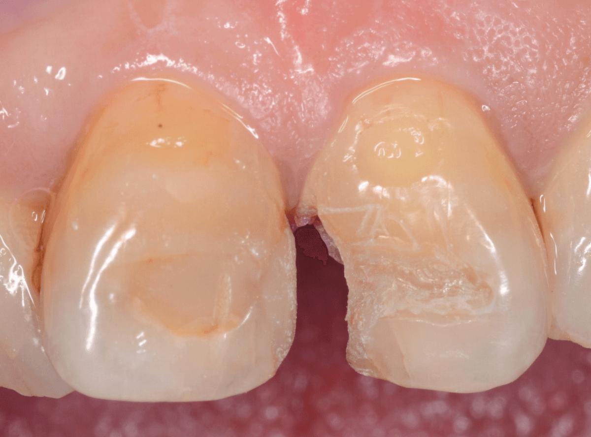 コンポジットレジン治療3-4