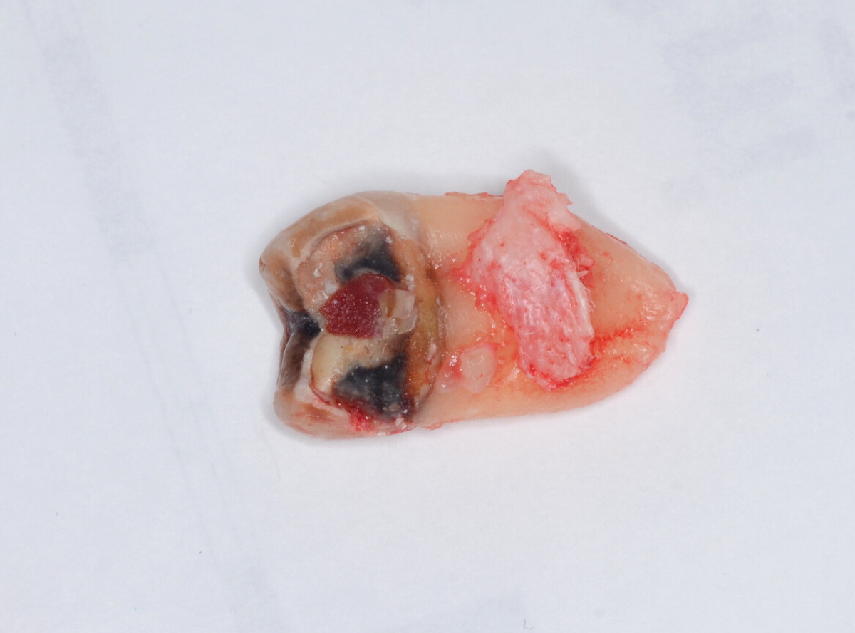 おやしらずの抜歯5-2