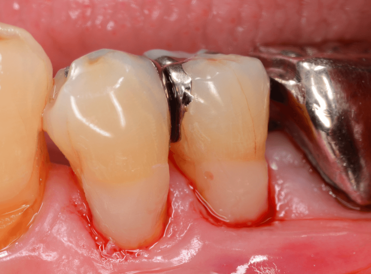 コンポジットレジン治療4-3