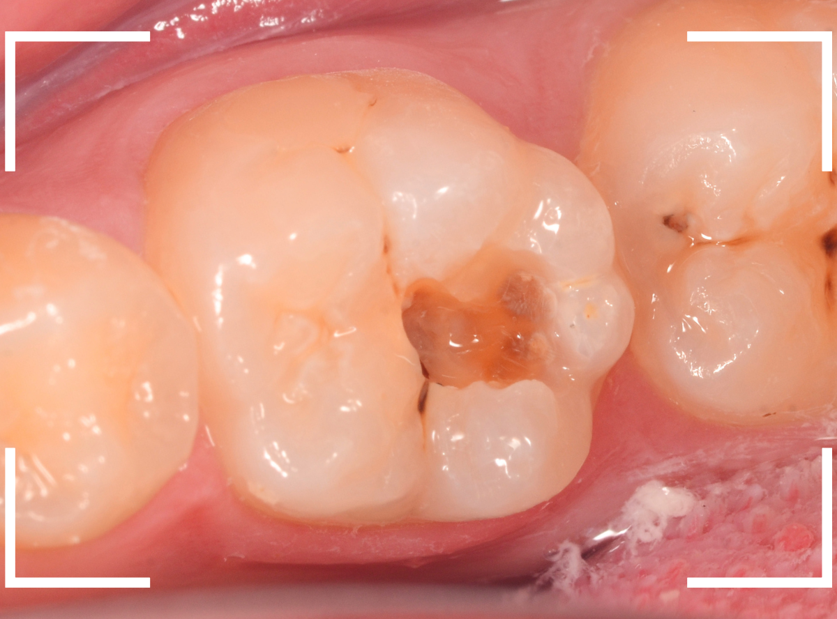 小窩裂溝う蝕5-3