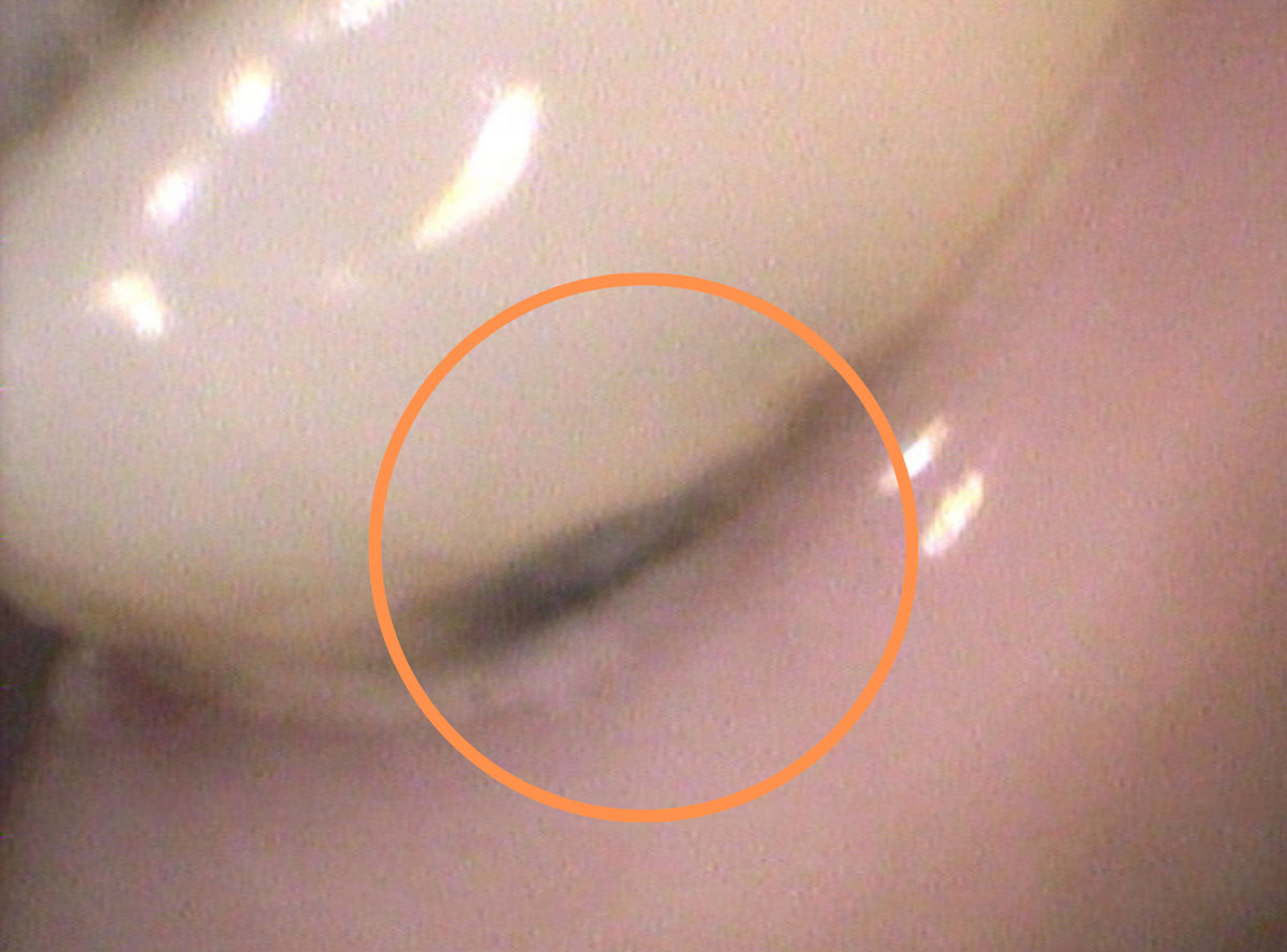 歯と歯の間の虫歯5-5