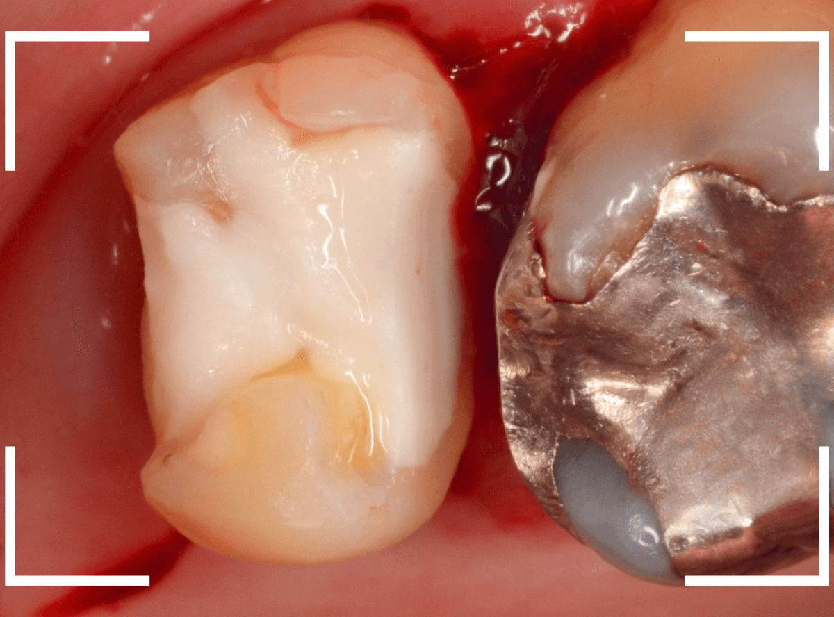 つめものの下の深い虫歯(画像)10-1
