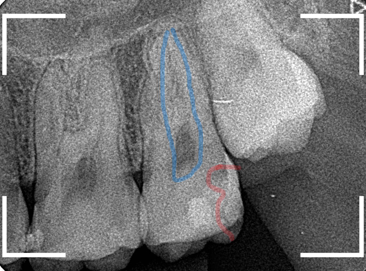 気づかないうちに深い虫歯5-2