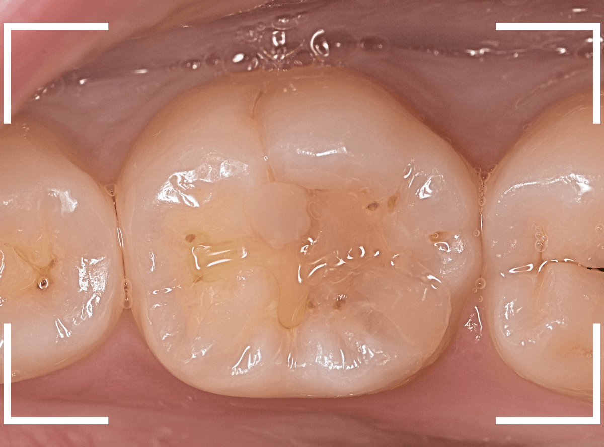 レントゲンでわかりづらい虫歯16-1