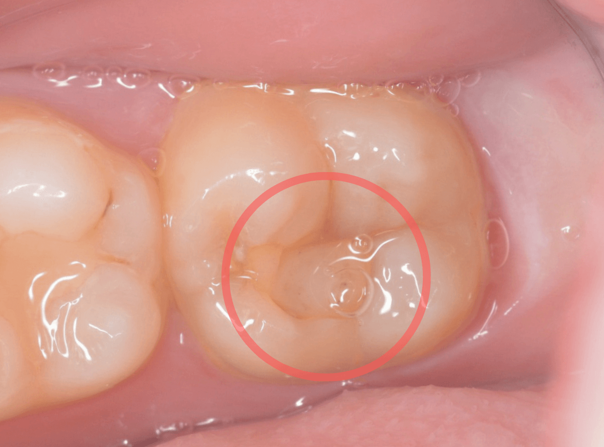 つめものの下の深い深い虫歯1-2
