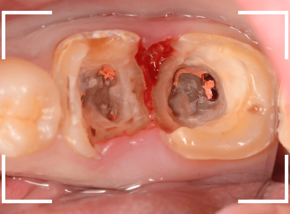 気づかないうちに深い虫歯15-5