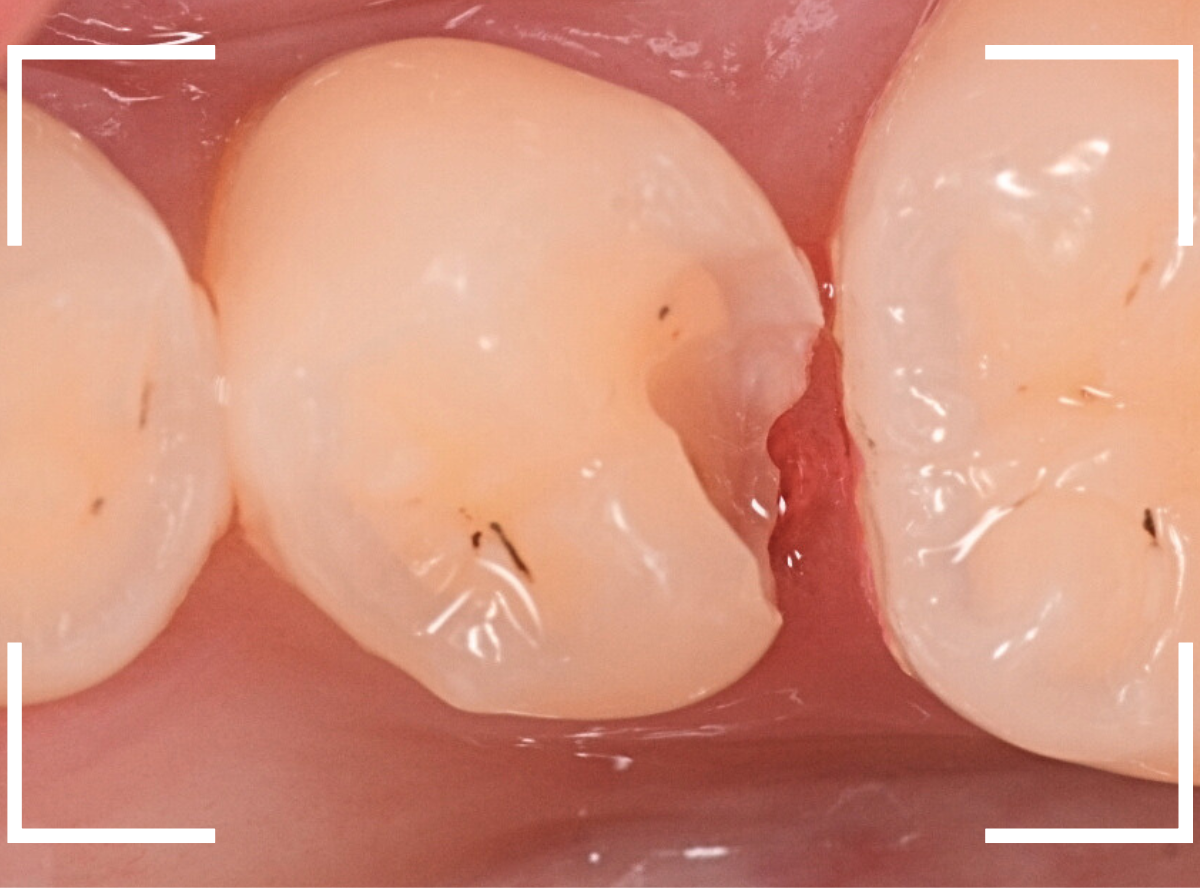 セラミック治療(インレー)23-4