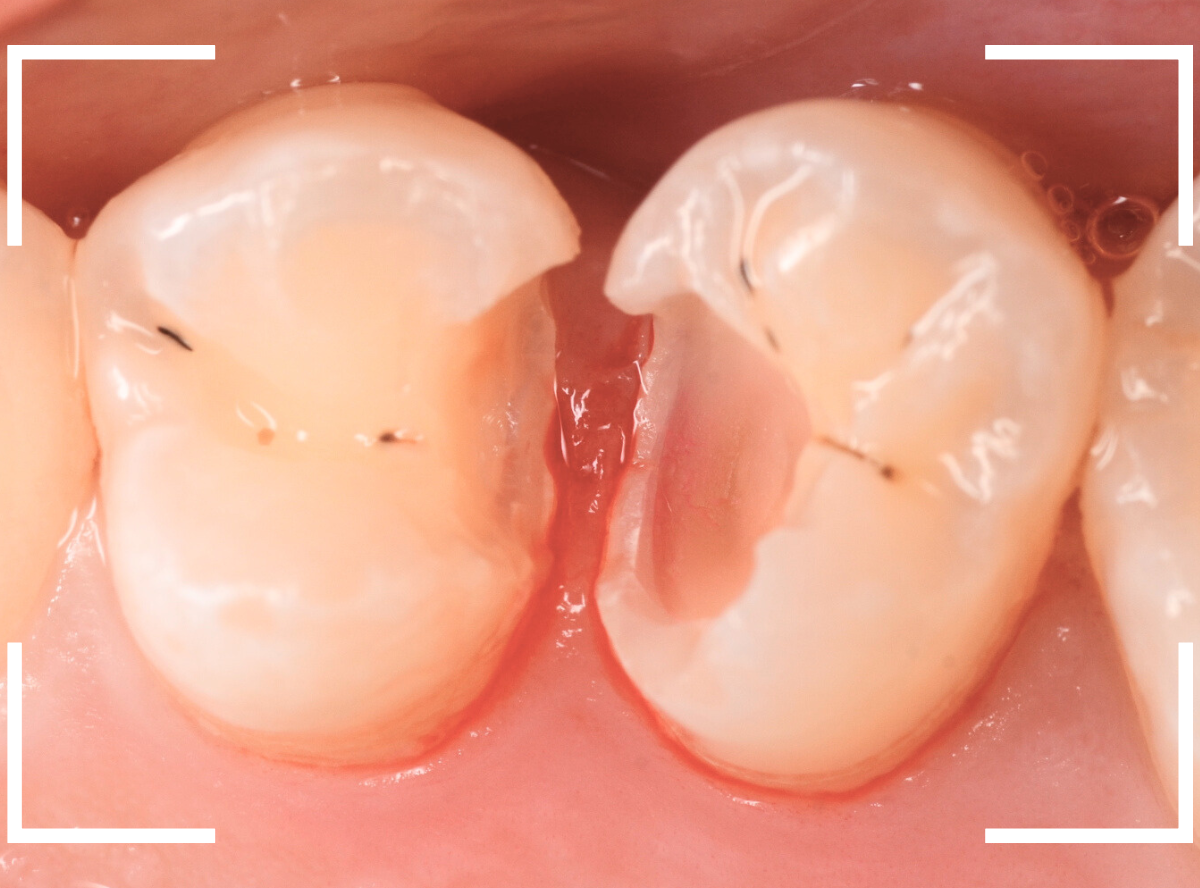 歯と歯の間の虫歯11-5
