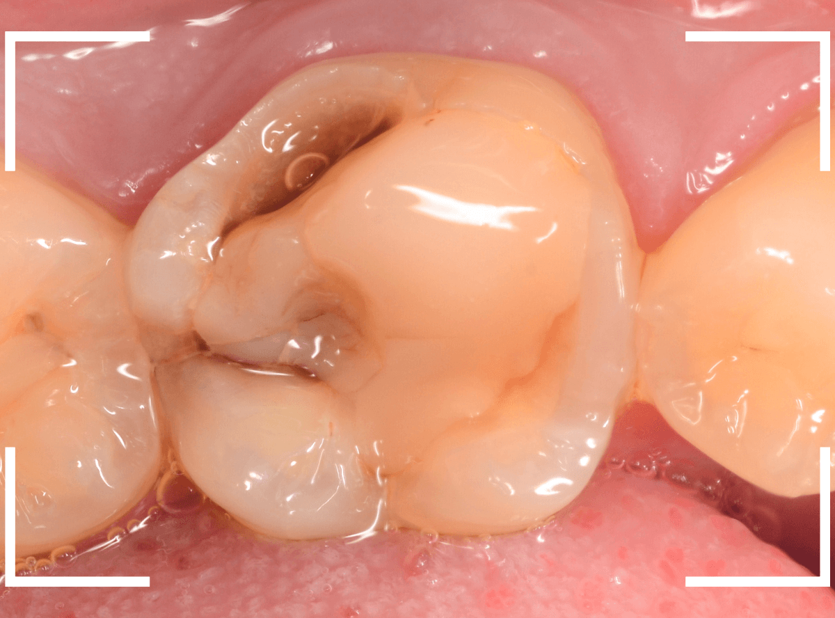 レントゲンでわかりづらい虫歯21-1
