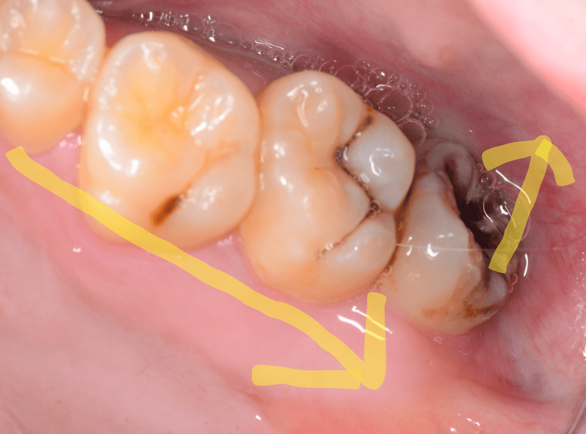 おやしらずの抜歯1-2