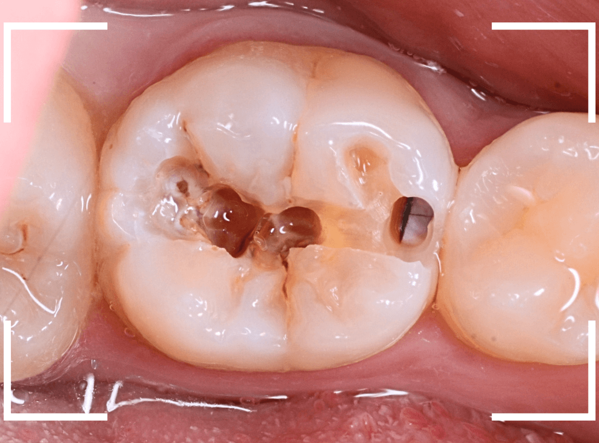 小窩裂溝う蝕1-4