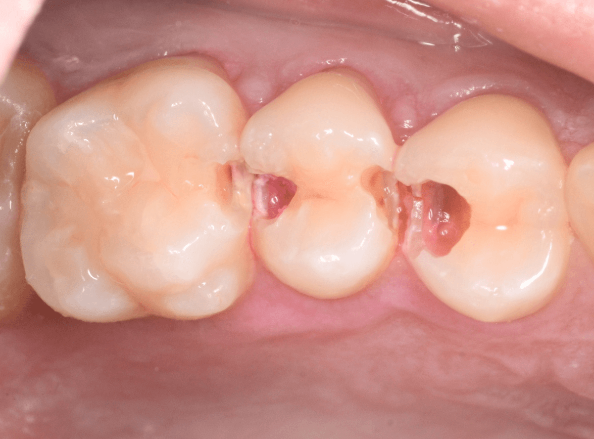 歯と歯の間の虫歯3-4