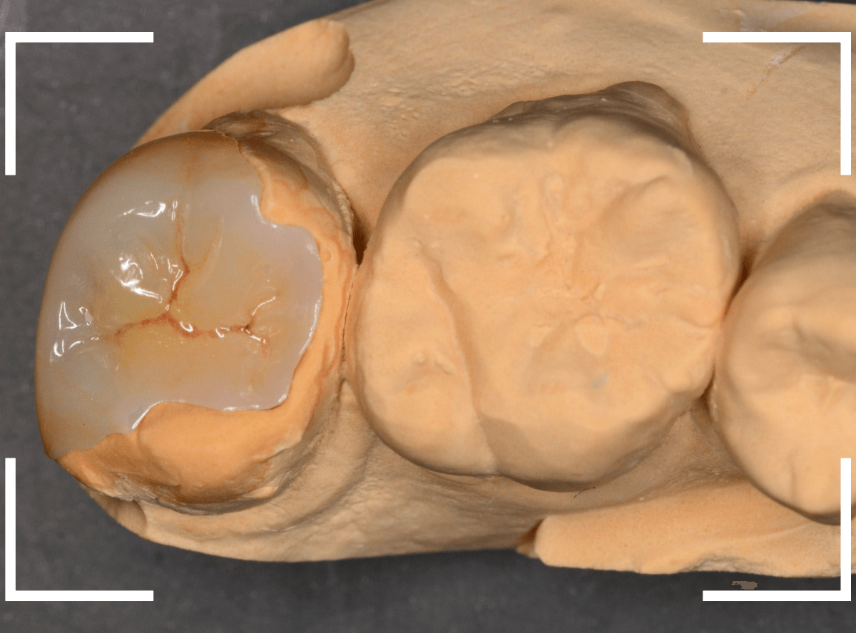 セラミック治療(インレー)31-3