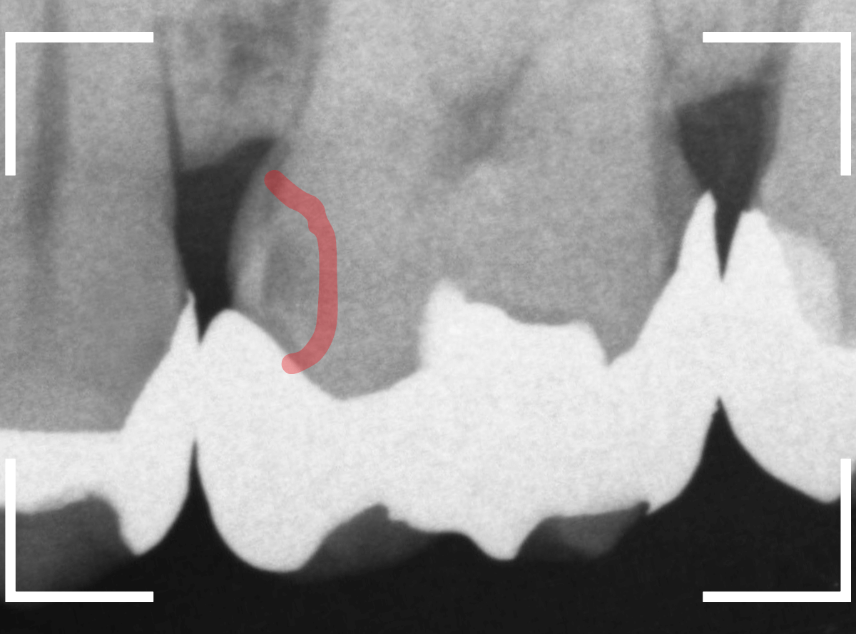 つめものの下の深い虫歯(画像)10-1