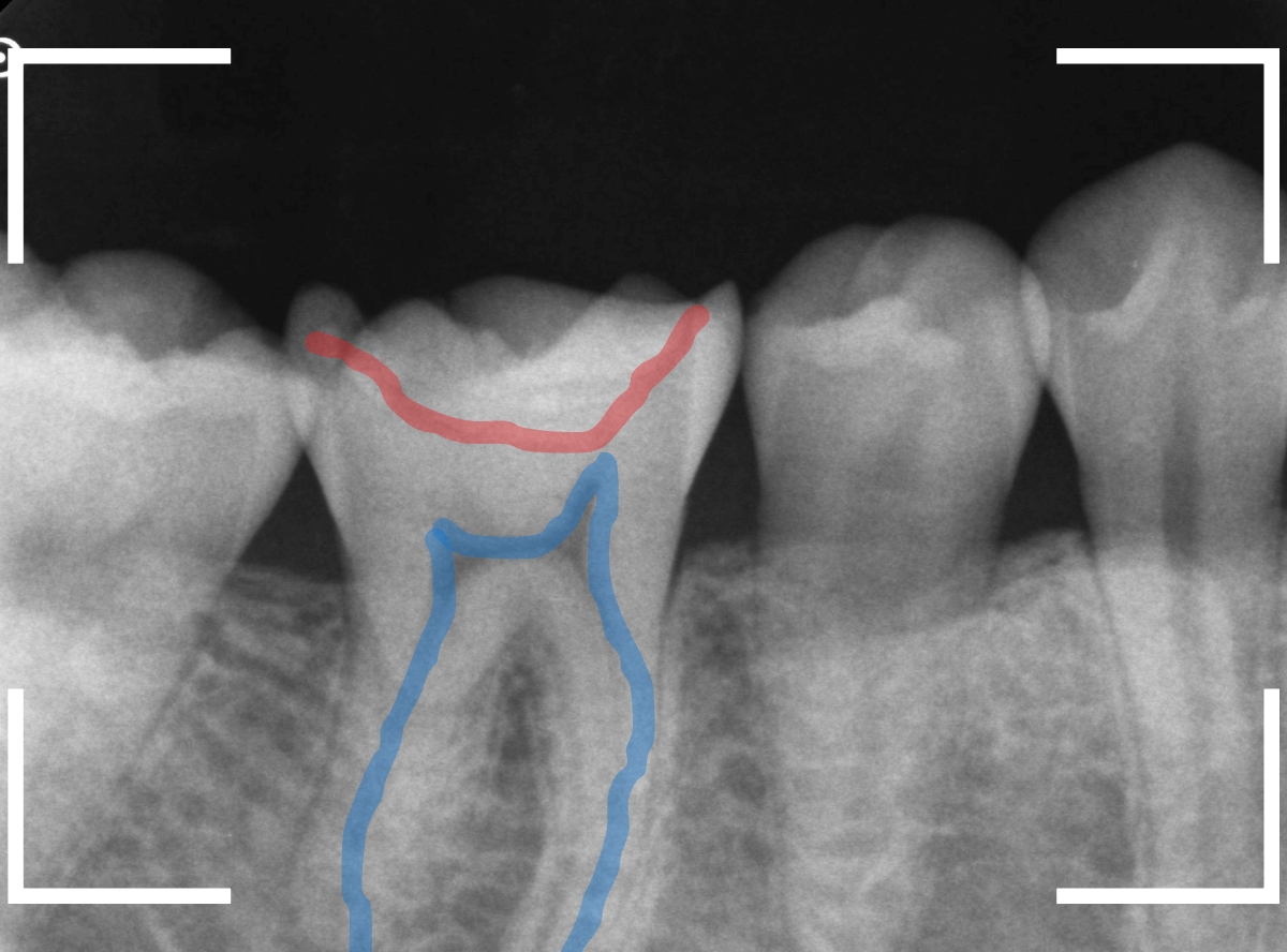 レントゲンでわかりづらい虫歯21-3