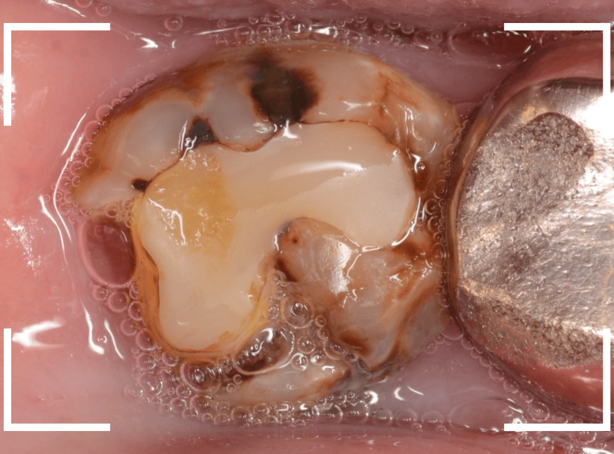 おやしらずの抜歯15-1