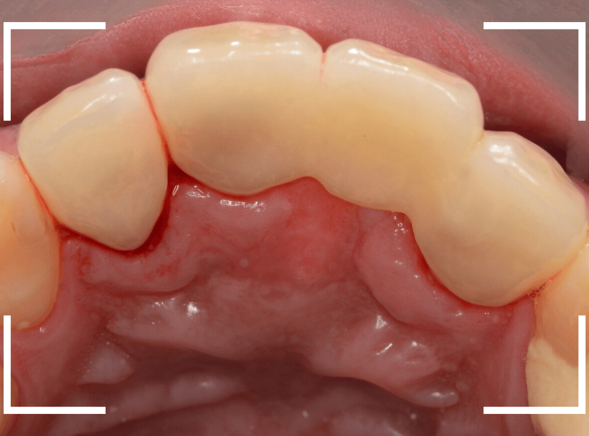 セラミック治療(前歯・クラウン)4-8