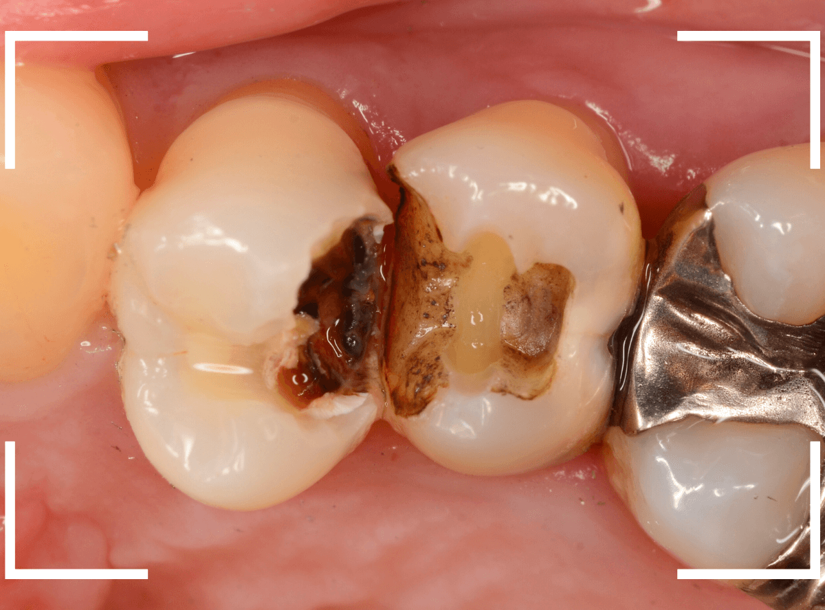 歯と歯の間の虫歯21-1
