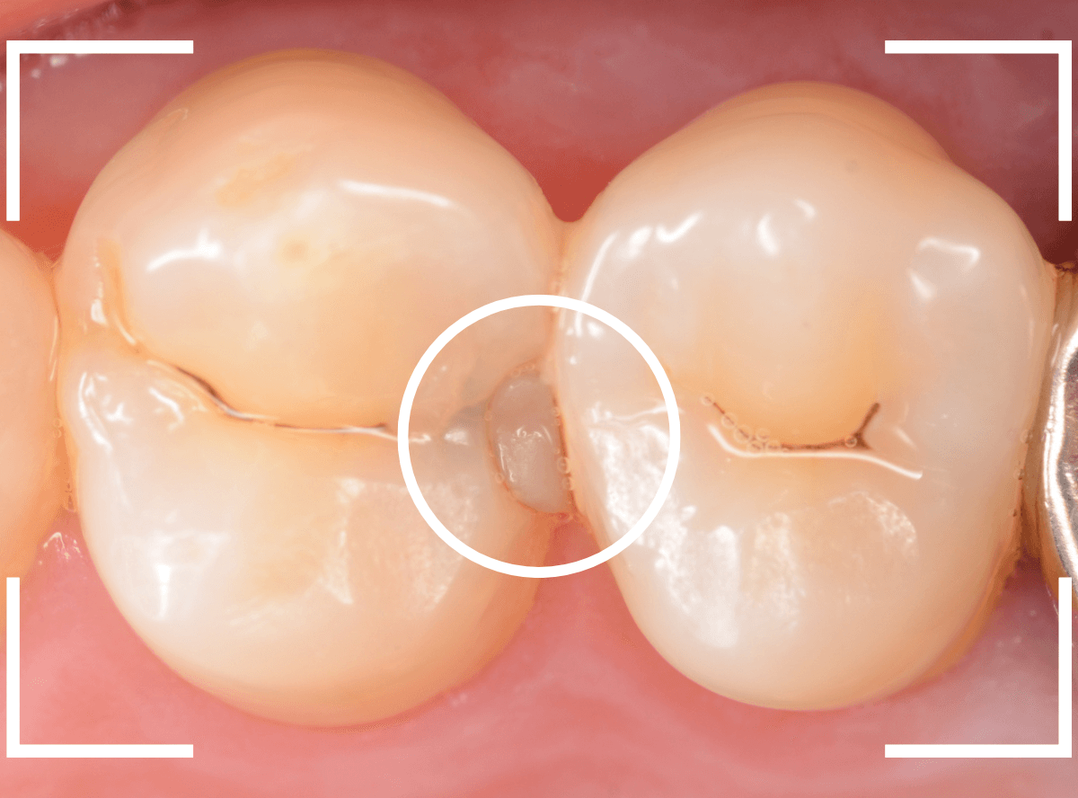 つめものの下の深い深い虫歯18-1