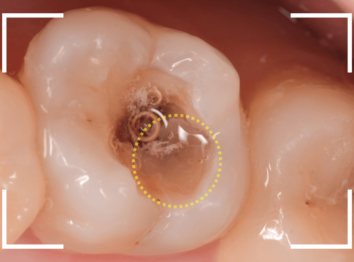 つめものの下の深い深い虫歯20-1