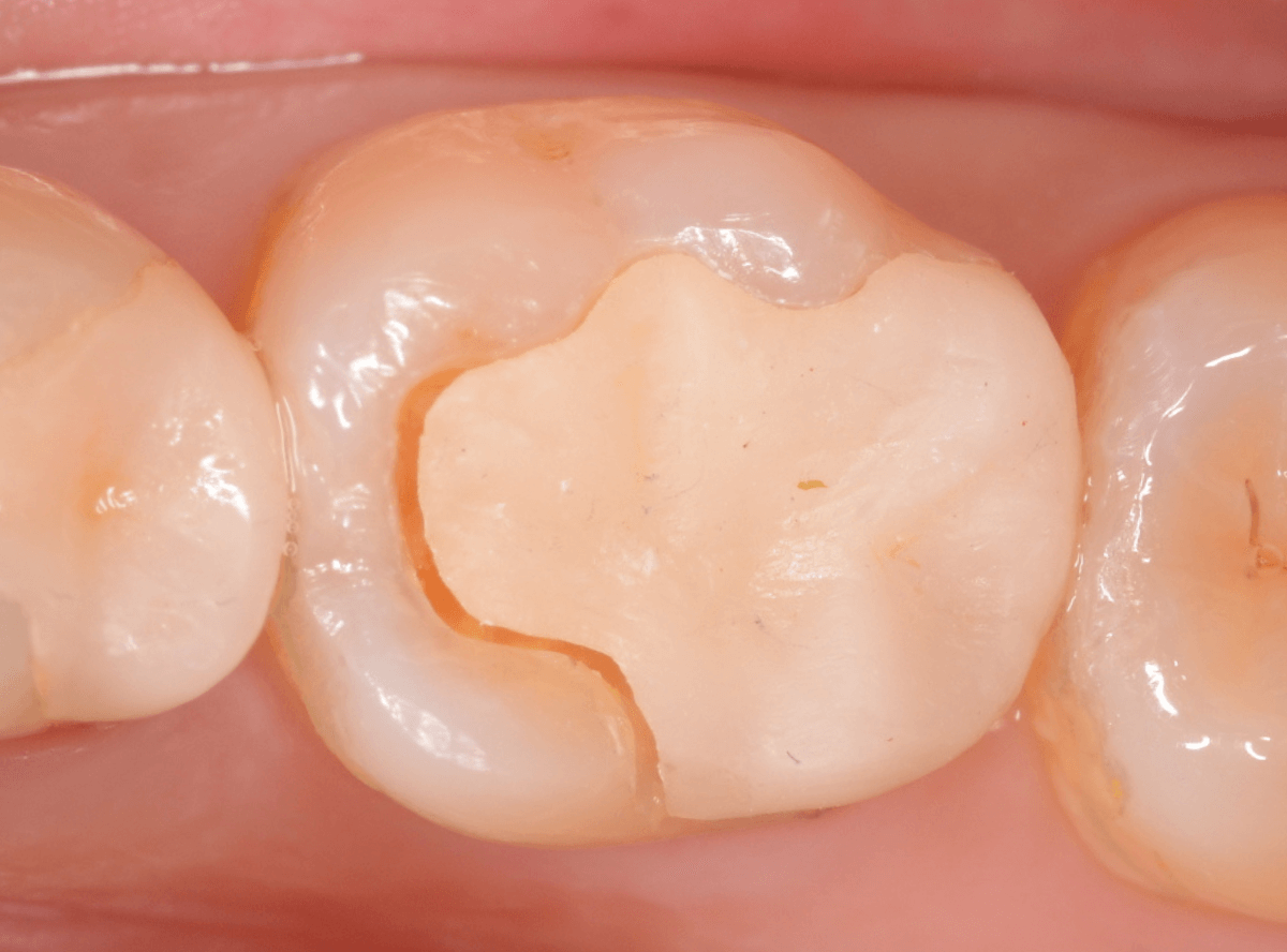 セラミック治療(インレー)12-1