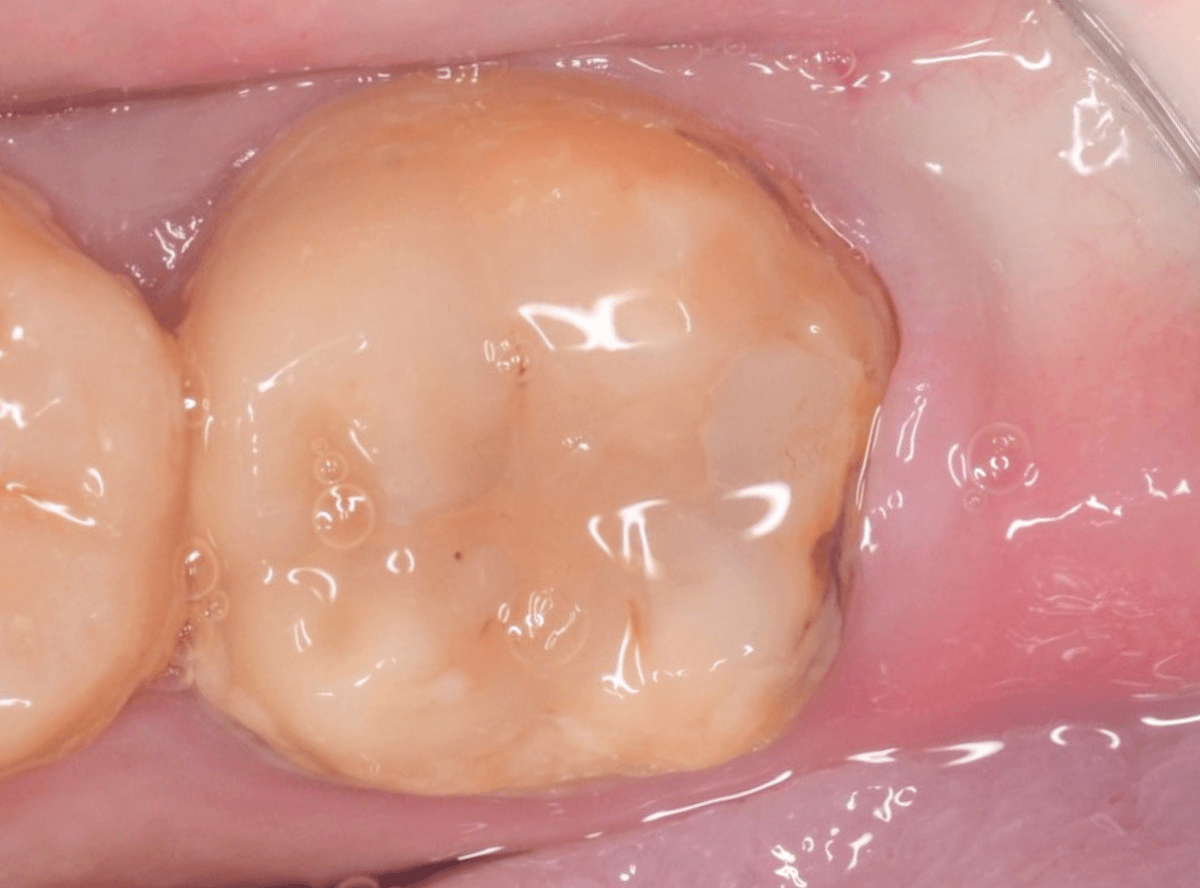 つめものの下の深い深い虫歯2-1