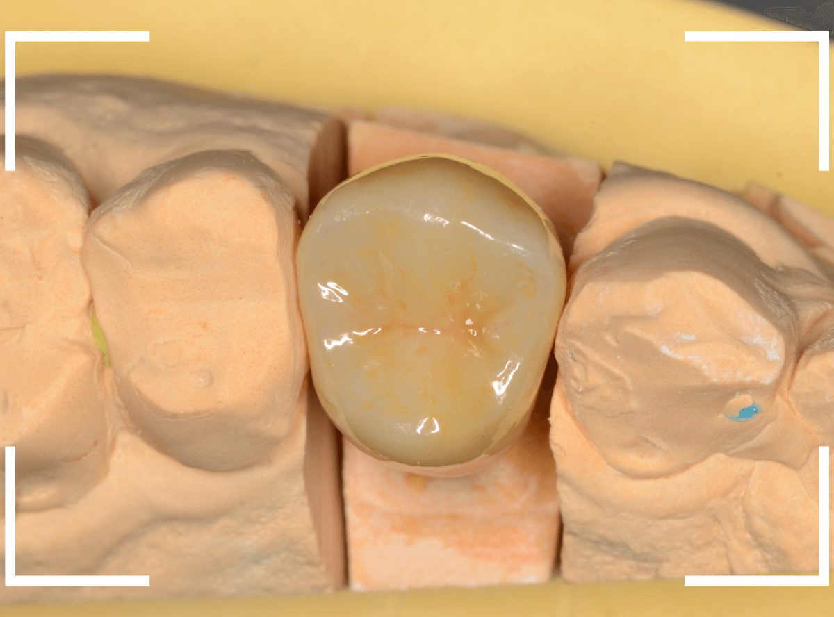 セラミック治療(クラウン・奥歯)14-1