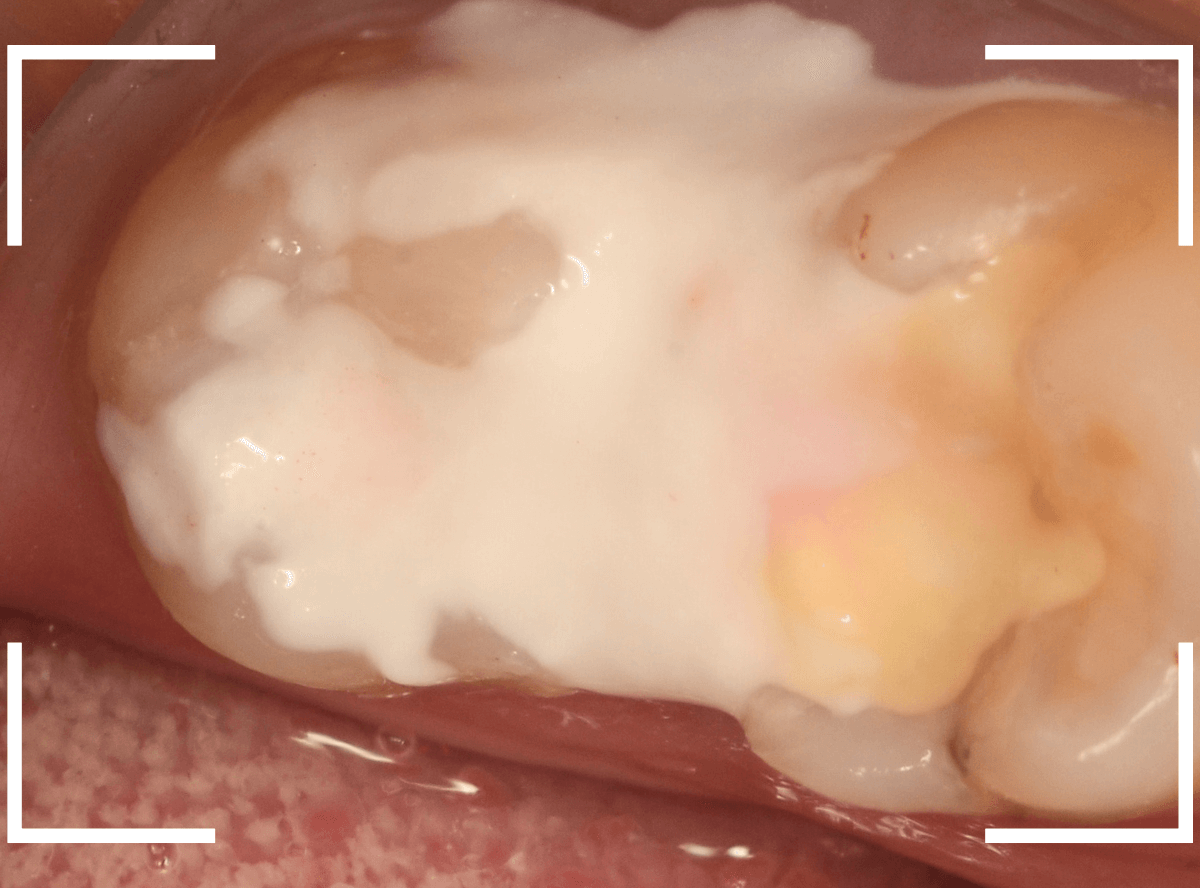 歯と歯の間の虫歯23-10