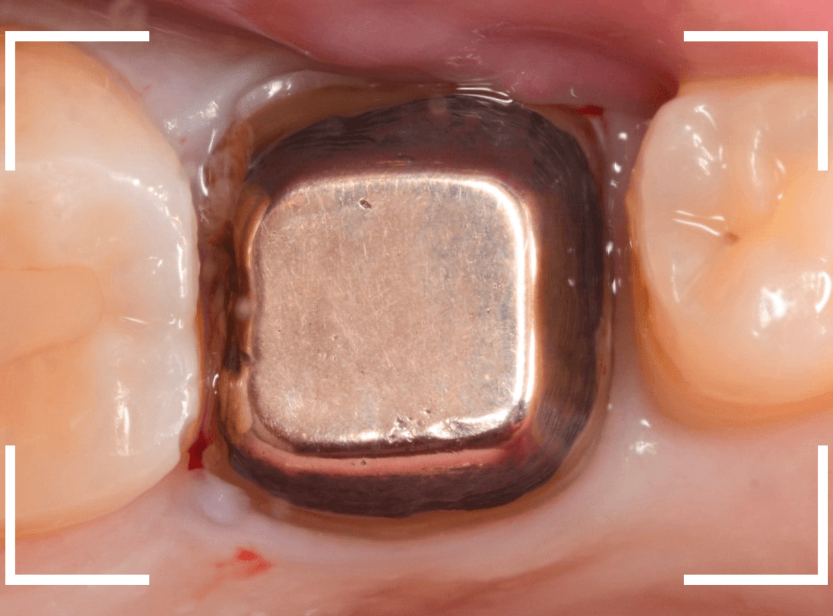 歯の土台の再治療1-1